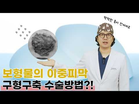 피막이 두껍지 않아도 구형구축이 생길 수 있다? 이중피막의 구형구축! #구형구축 #이중피막 #가슴재수술 UBA254